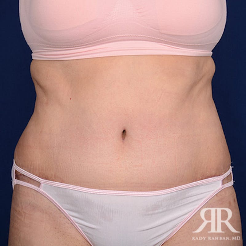 Tummy Tuck Before & After Gallery - Patient 243005 - Image 2