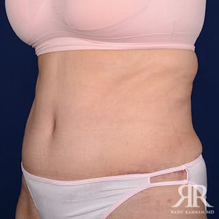 Tummy Tuck Before & After Gallery - Patient 243005 - Image 4