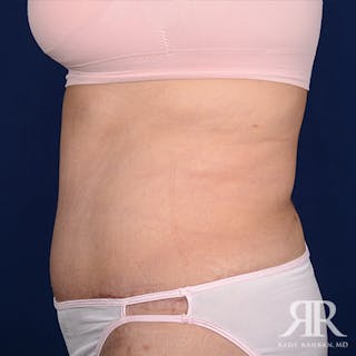 Tummy Tuck Before & After Gallery - Patient 243005 - Image 6