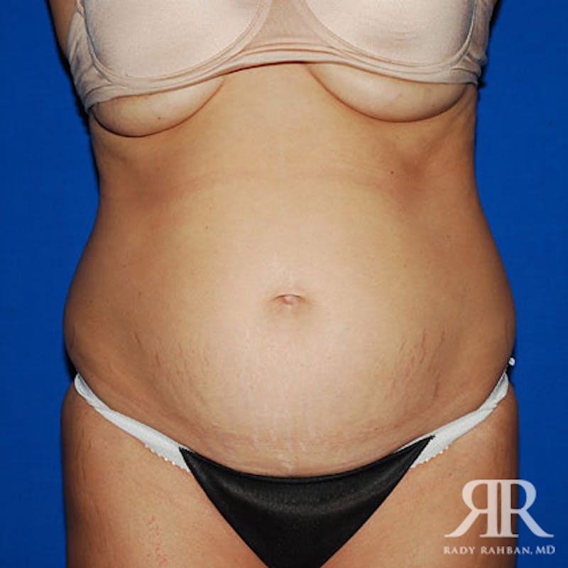 Tummy Tuck Before & After Gallery - Patient 429127 - Image 1