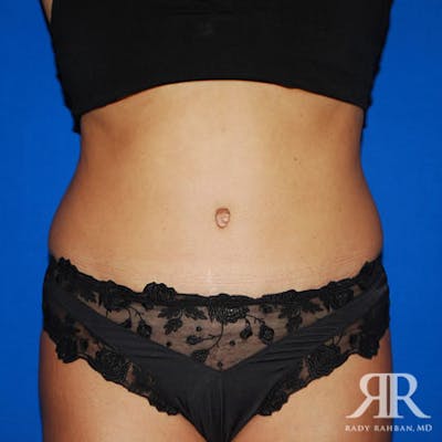 Tummy Tuck Before & After Gallery - Patient 429127 - Image 2