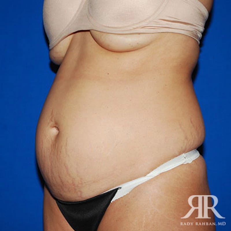 Tummy Tuck Before & After Gallery - Patient 429127 - Image 3