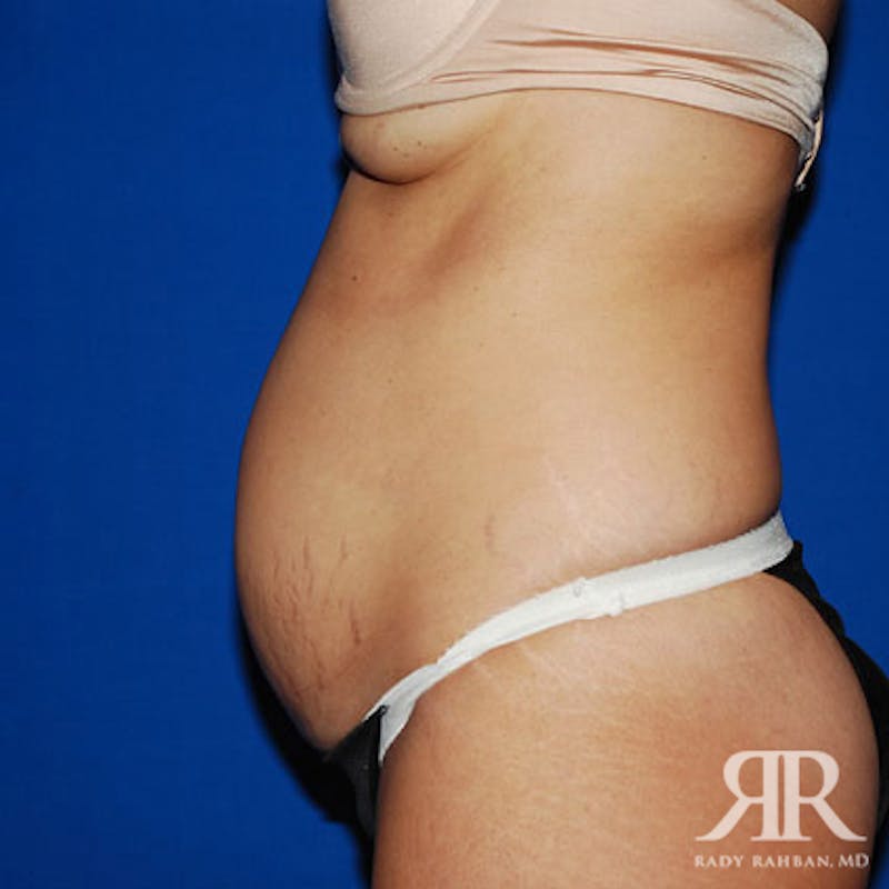 Tummy Tuck Before & After Gallery - Patient 429127 - Image 5