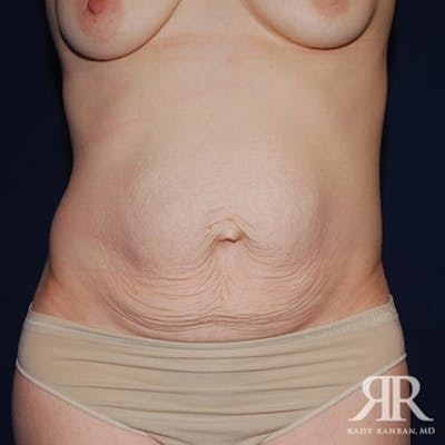 Tummy Tuck Before & After Gallery - Patient 195024 - Image 1