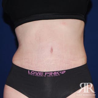 Tummy Tuck Before & After Gallery - Patient 195024 - Image 2