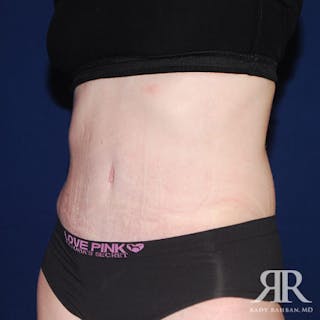Tummy Tuck Before & After Gallery - Patient 195024 - Image 4