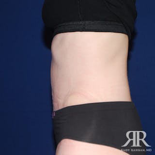 Tummy Tuck Before & After Gallery - Patient 195024 - Image 6