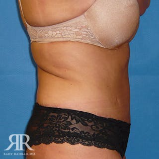 Tummy Tuck Before & After Gallery - Patient 293874 - Image 6