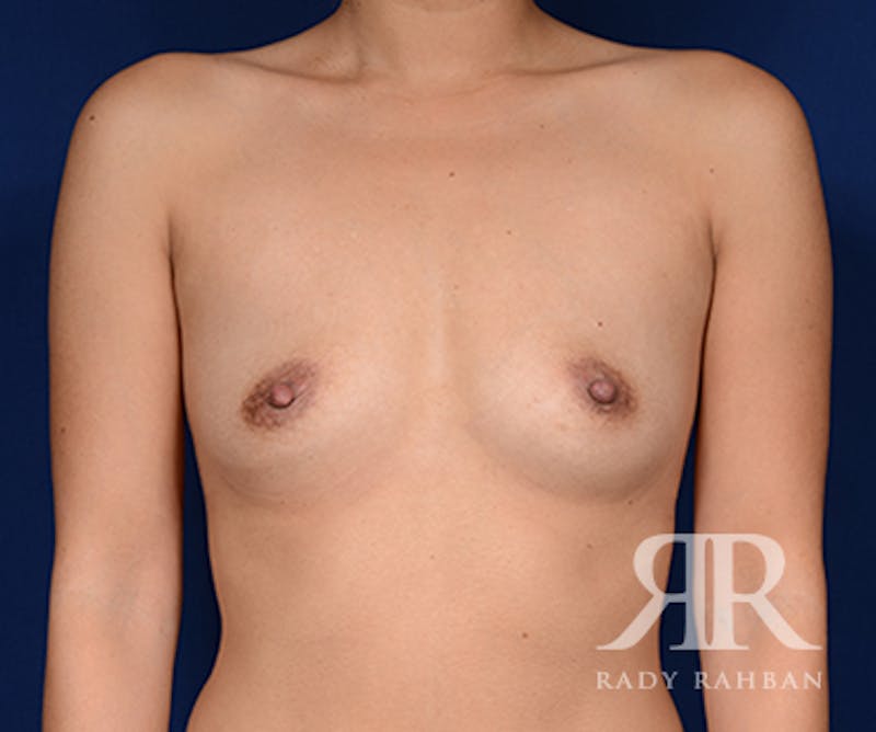 Breast Augmentation Before & After Gallery - Patient 188037 - Image 1