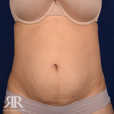 Tummy Tuck Before & After Gallery - Patient 179814 - Image 1