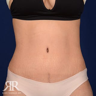 Tummy Tuck Before & After Gallery - Patient 179814 - Image 2