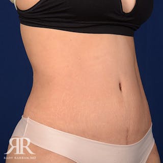 Tummy Tuck Before & After Gallery - Patient 179814 - Image 4
