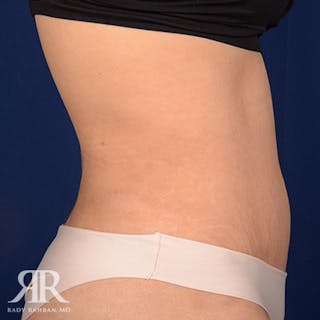 Tummy Tuck Before & After Gallery - Patient 179814 - Image 6