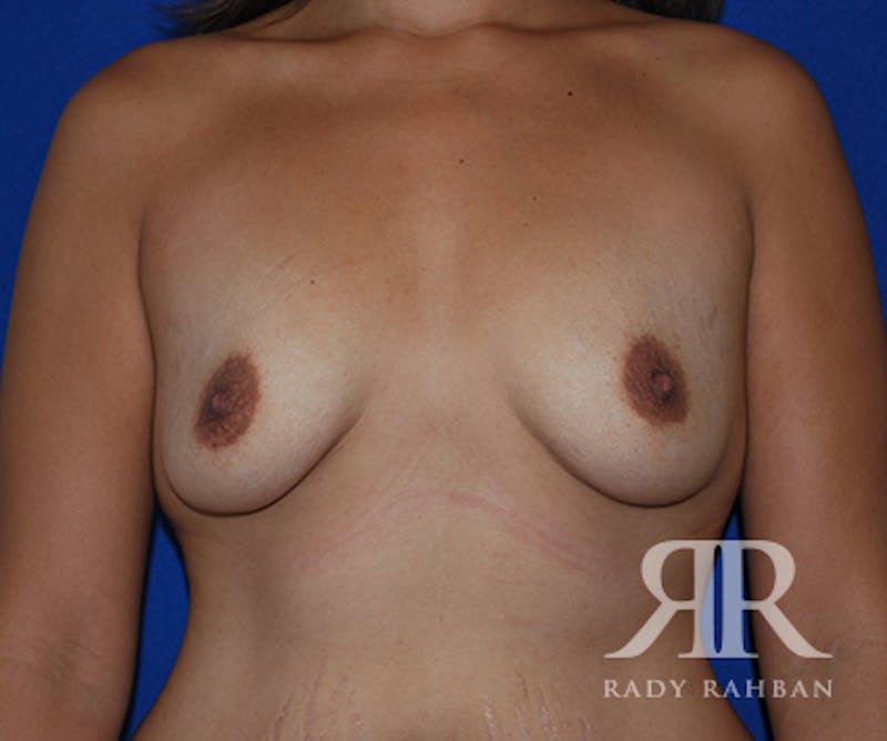 Breast Augmentation Before & After Gallery - Patient 333141 - Image 1