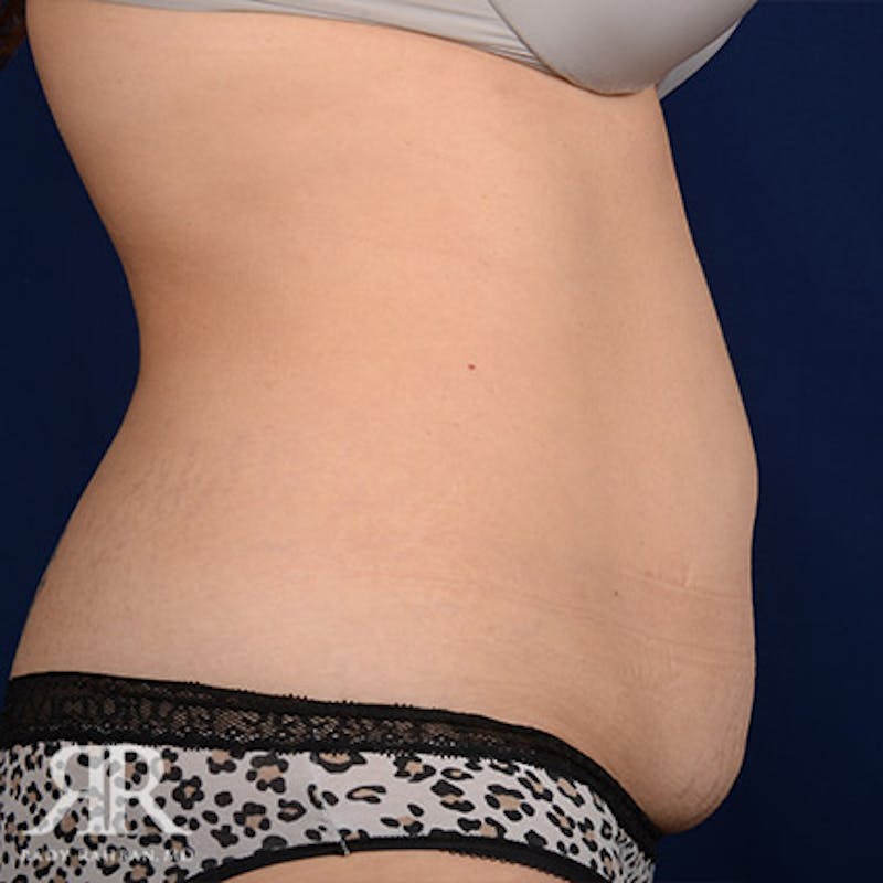 Tummy Tuck Before & After Gallery - Patient 118111 - Image 5