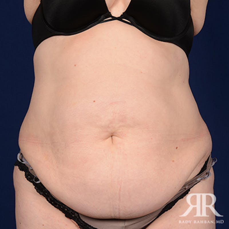 Tummy Tuck Before & After Gallery - Patient 367031 - Image 1