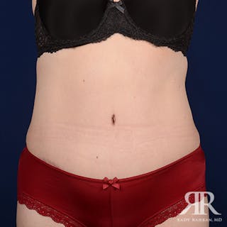 Tummy Tuck Before & After Gallery - Patient 367031 - Image 2