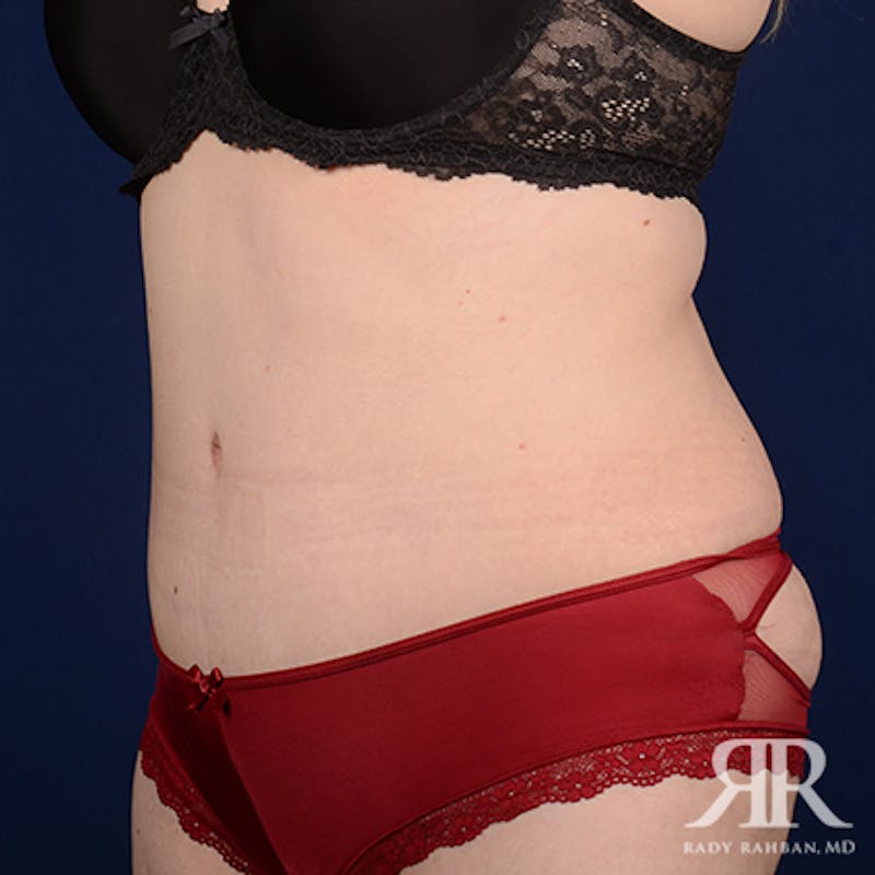 Tummy Tuck Before & After Gallery - Patient 367031 - Image 4