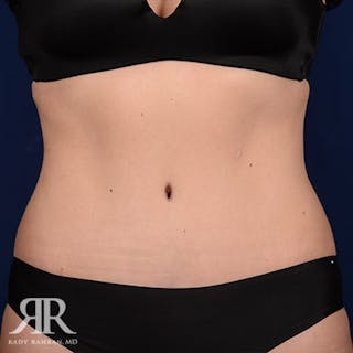Tummy Tuck Before & After Gallery - Patient 100318 - Image 2