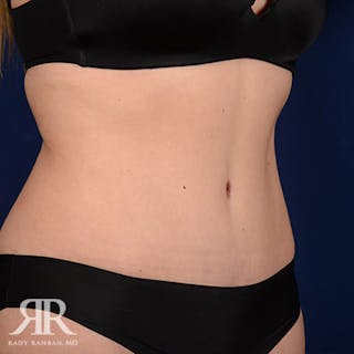 Tummy Tuck Before & After Gallery - Patient 100318 - Image 4
