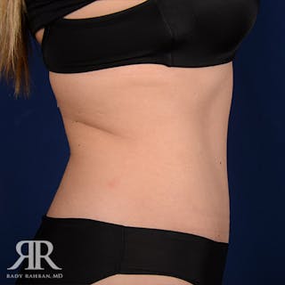 Tummy Tuck Before & After Gallery - Patient 100318 - Image 6