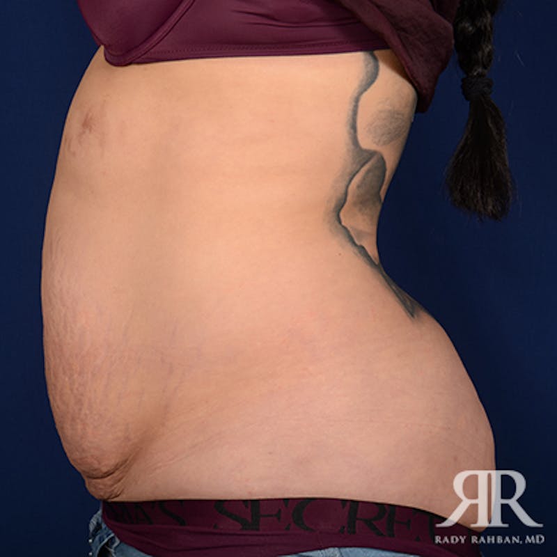 Tummy Tuck Before & After Gallery - Patient 172597 - Image 5