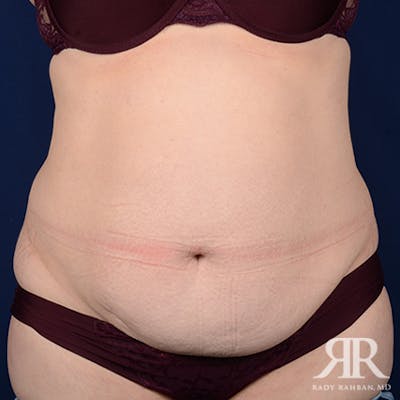 Tummy Tuck Before & After Gallery - Patient 508718 - Image 1