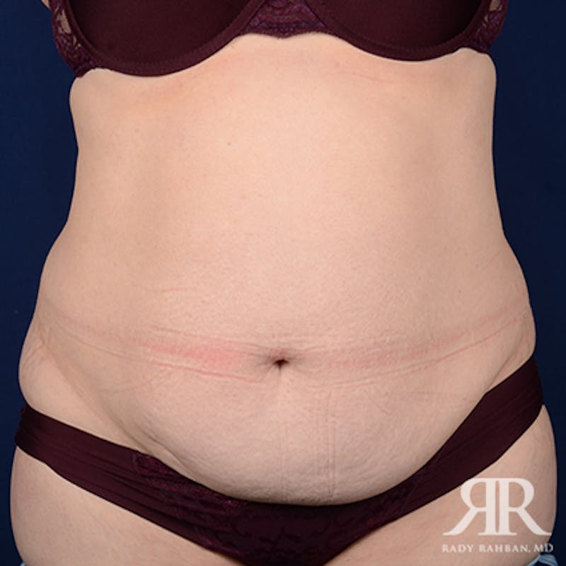 Tummy Tuck Before & After Gallery - Patient 508718 - Image 1