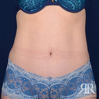 Tummy Tuck Before & After Gallery - Patient 508718 - Image 2