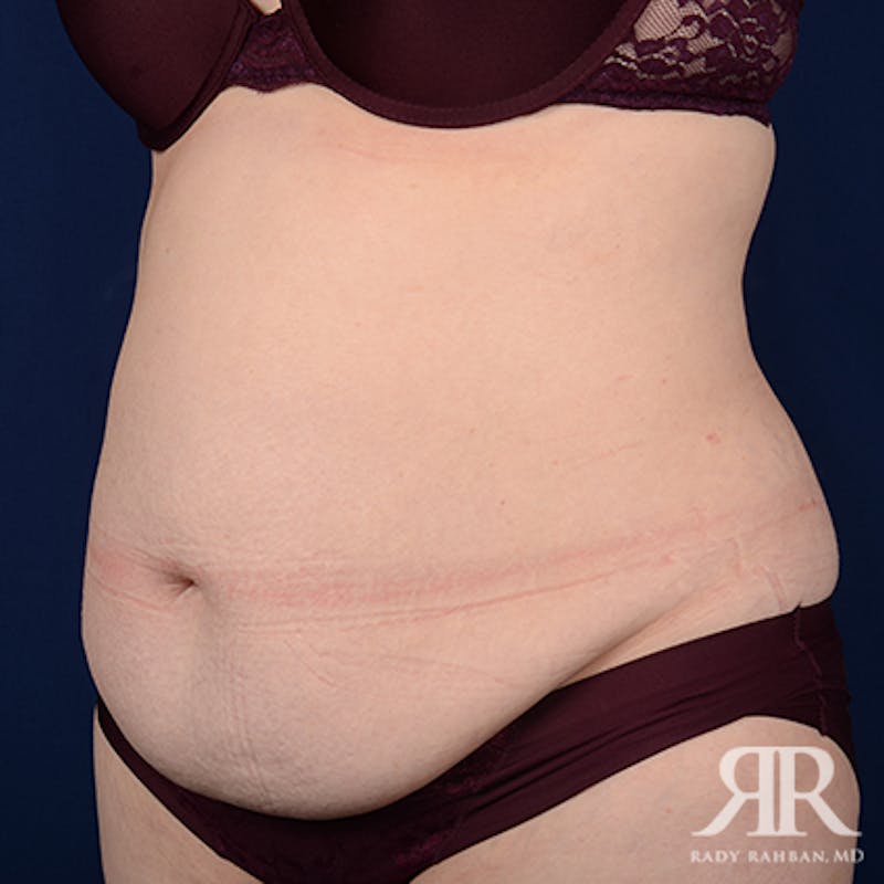 Tummy Tuck Before & After Gallery - Patient 508718 - Image 3