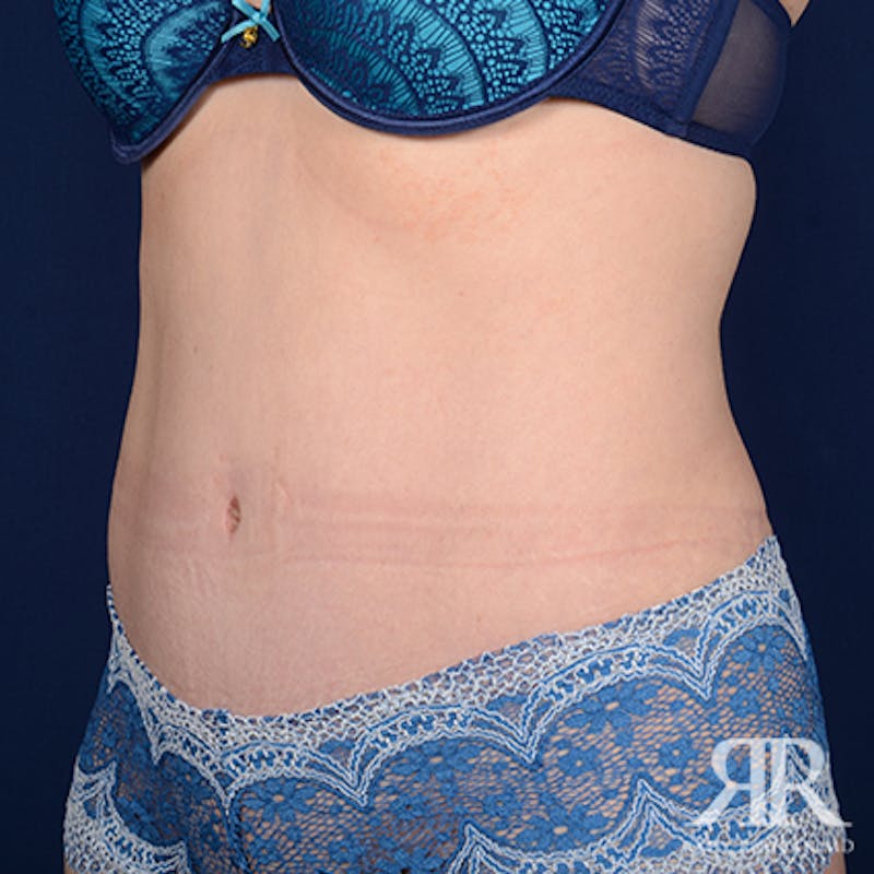 Tummy Tuck Before & After Gallery - Patient 508718 - Image 4