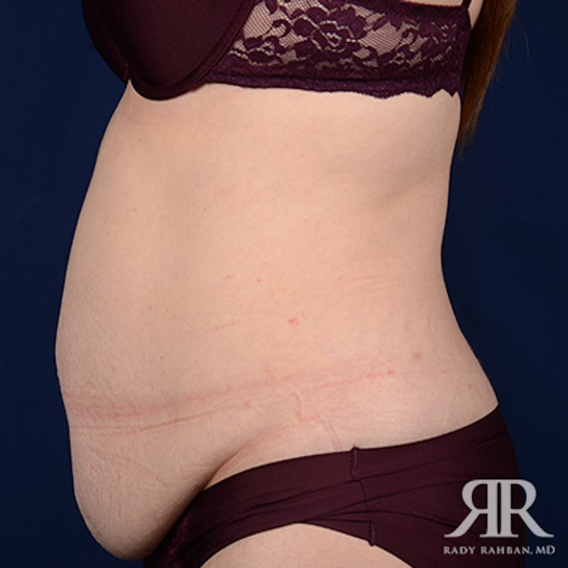 Tummy Tuck Before & After Gallery - Patient 508718 - Image 5