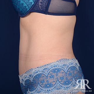 Tummy Tuck Before & After Gallery - Patient 508718 - Image 6