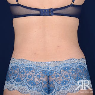 Tummy Tuck Before & After Gallery - Patient 508718 - Image 8