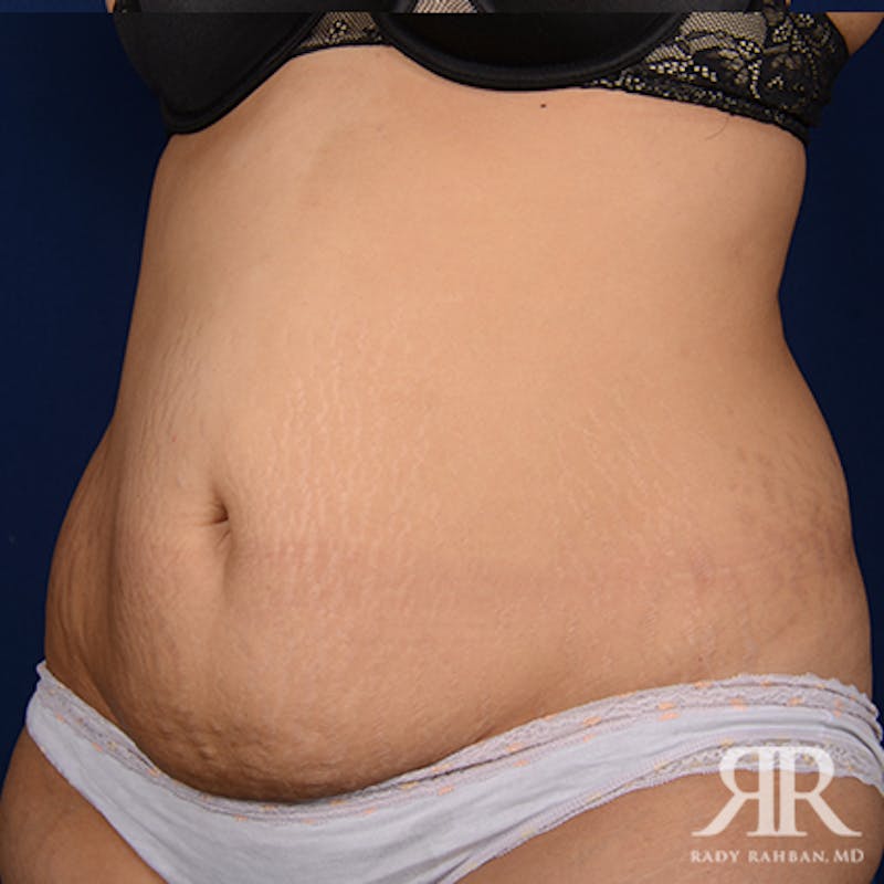 Tummy Tuck Before & After Gallery - Patient 159138 - Image 3