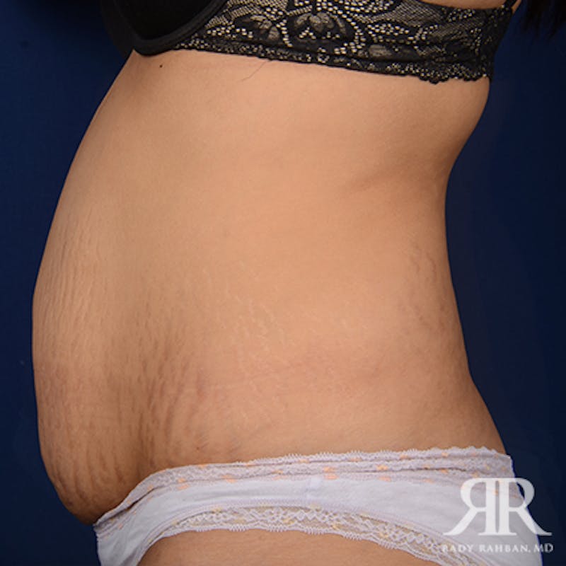Tummy Tuck Before & After Gallery - Patient 159138 - Image 5