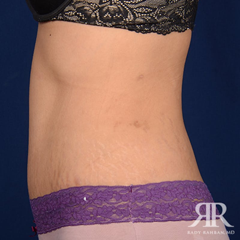 Tummy Tuck Before & After Gallery - Patient 159138 - Image 6