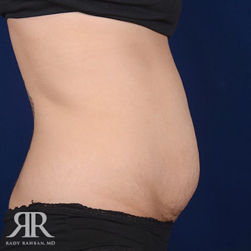 Tummy Tuck Before & After Gallery - Patient 238502 - Image 5