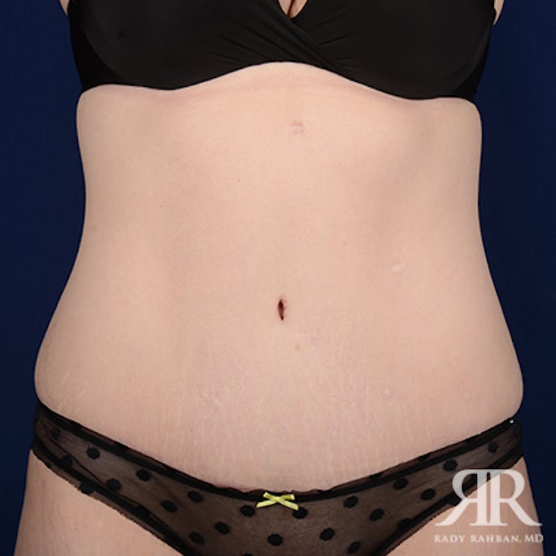 Tummy Tuck Before & After Gallery - Patient 114137 - Image 2