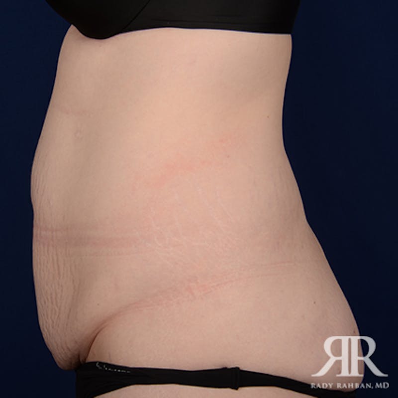 Tummy Tuck Before & After Gallery - Patient 114137 - Image 5