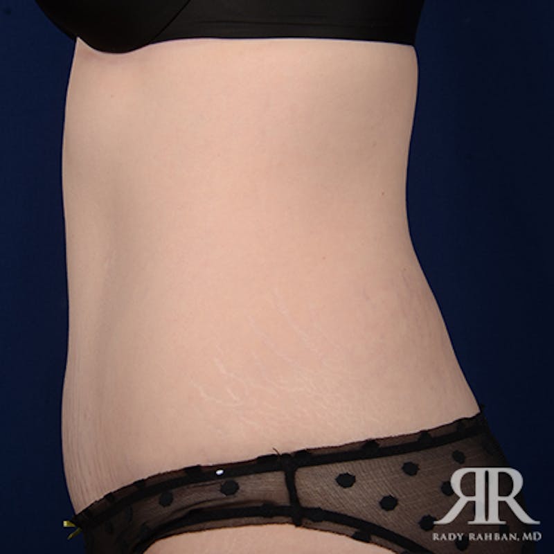 Tummy Tuck Before & After Gallery - Patient 114137 - Image 6