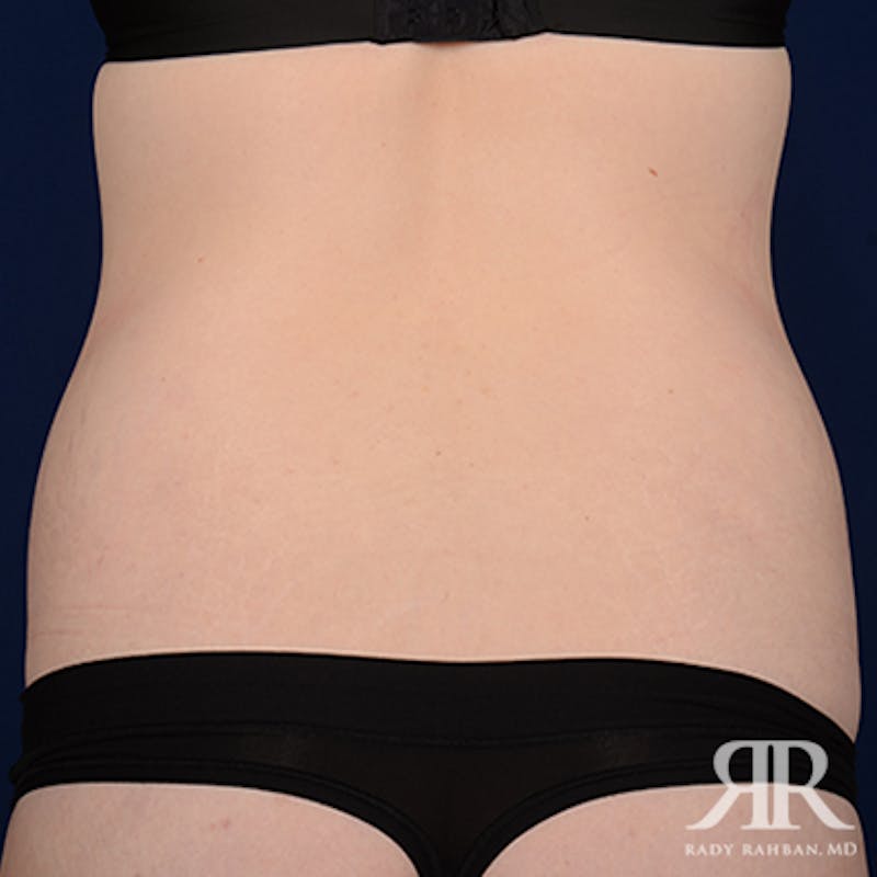 Tummy Tuck Before & After Gallery - Patient 114137 - Image 7