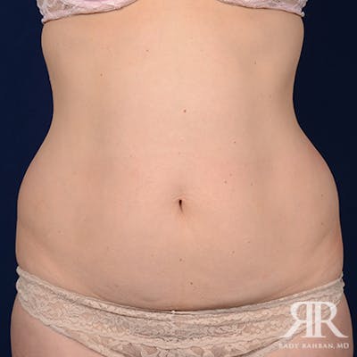 Tummy Tuck Before & After Gallery - Patient 111531 - Image 1