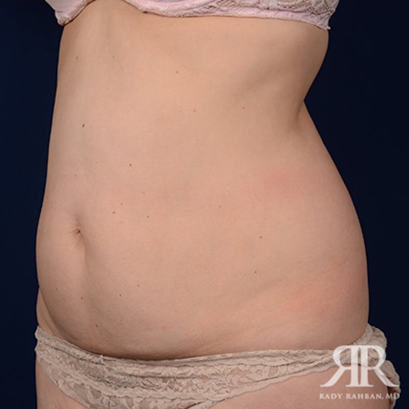 Tummy Tuck Before & After Gallery - Patient 111531 - Image 3