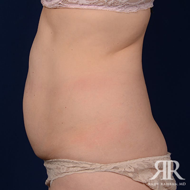 Tummy Tuck Before & After Gallery - Patient 111531 - Image 5
