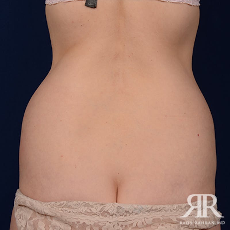 Tummy Tuck Before & After Gallery - Patient 111531 - Image 7