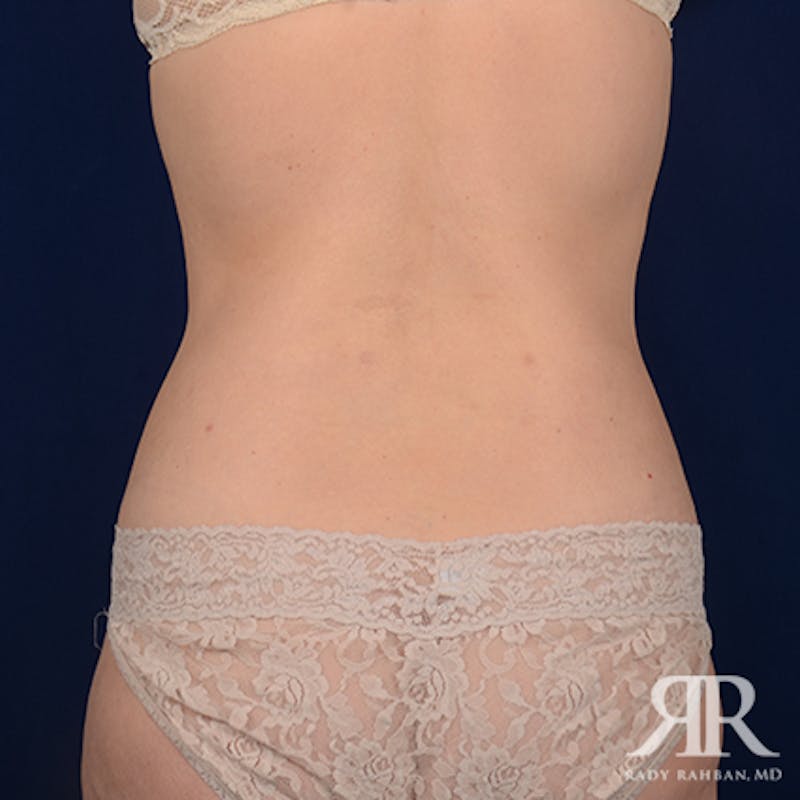 Tummy Tuck Before & After Gallery - Patient 111531 - Image 8