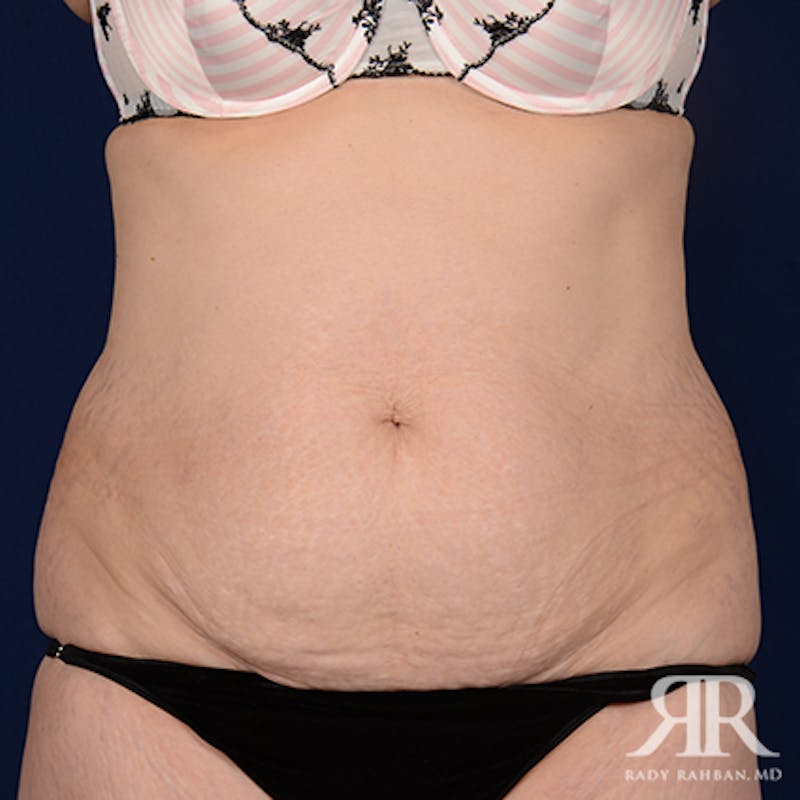 Tummy Tuck Before & After Gallery - Patient 386455 - Image 1