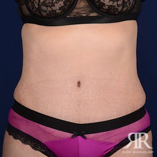 Tummy Tuck Before & After Gallery - Patient 386455 - Image 2