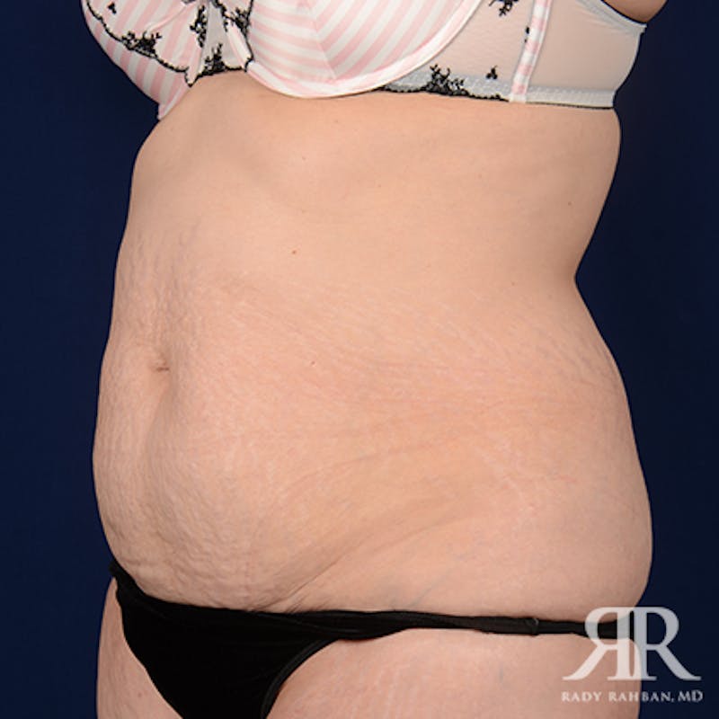 Tummy Tuck Before & After Gallery - Patient 386455 - Image 3